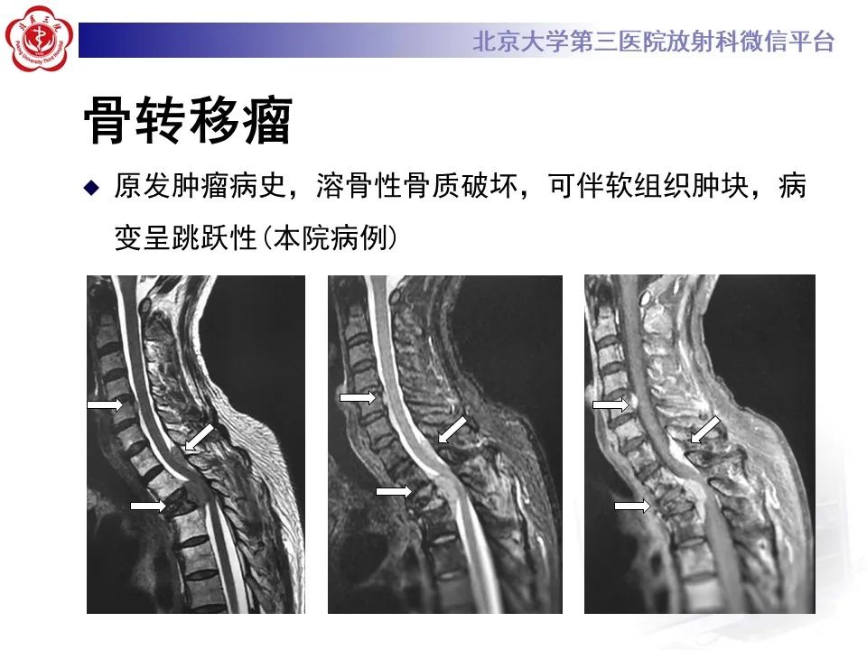 影像PPT - 【PPT】脊柱棕色瘤-29