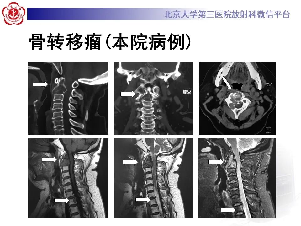 影像PPT - 【PPT】脊柱棕色瘤-30
