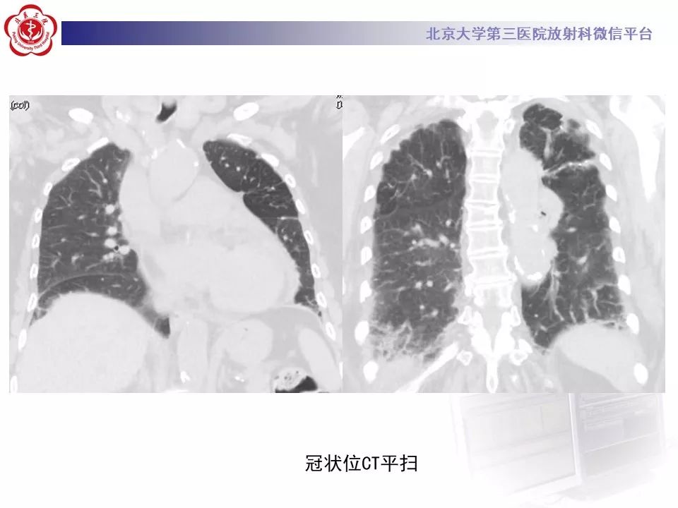 影像PPT - 【PPT】干燥综合征肺部表现-7