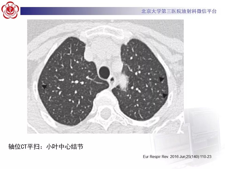 影像PPT - 【PPT】干燥综合征肺部表现-20