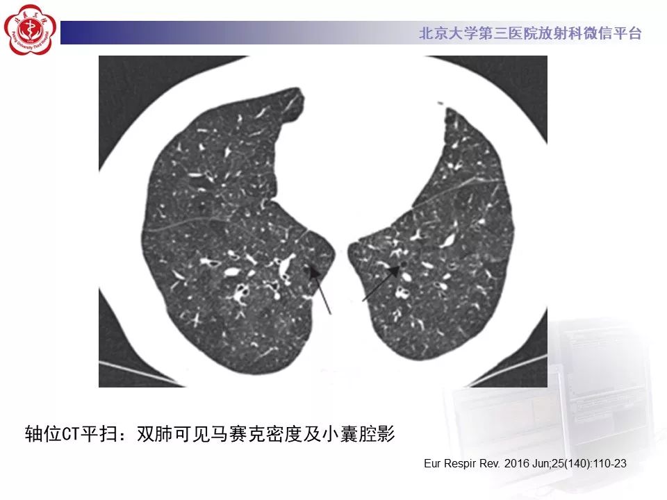影像PPT - 【PPT】干燥综合征肺部表现-21