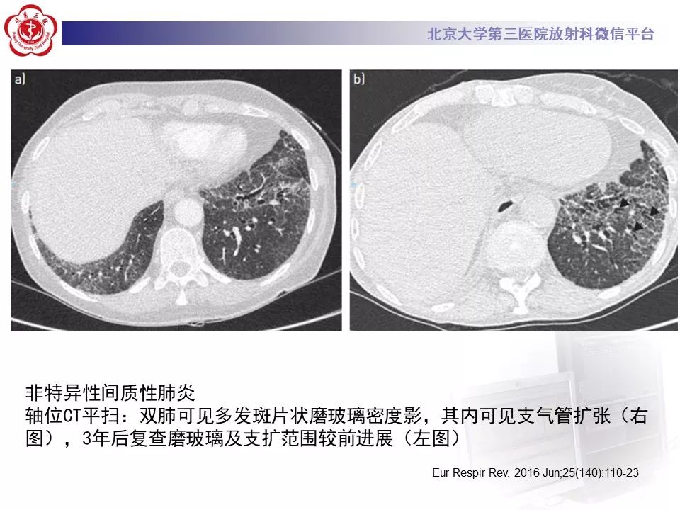 影像PPT - 【PPT】干燥综合征肺部表现-23
