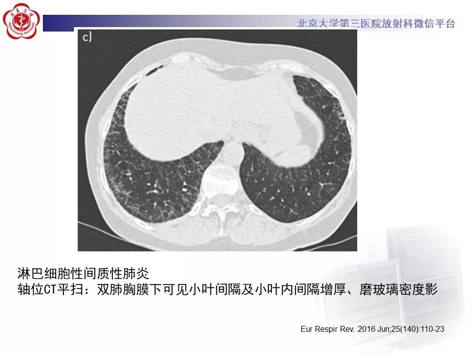 影像PPT - 【PPT】干燥综合征肺部表现-26