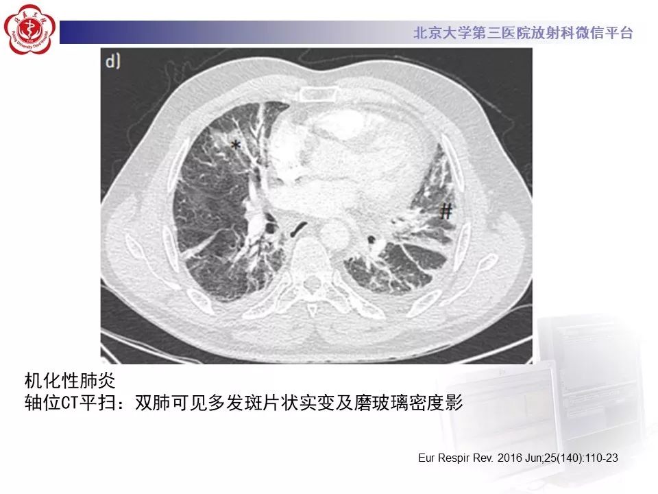 影像PPT - 【PPT】干燥综合征肺部表现-28