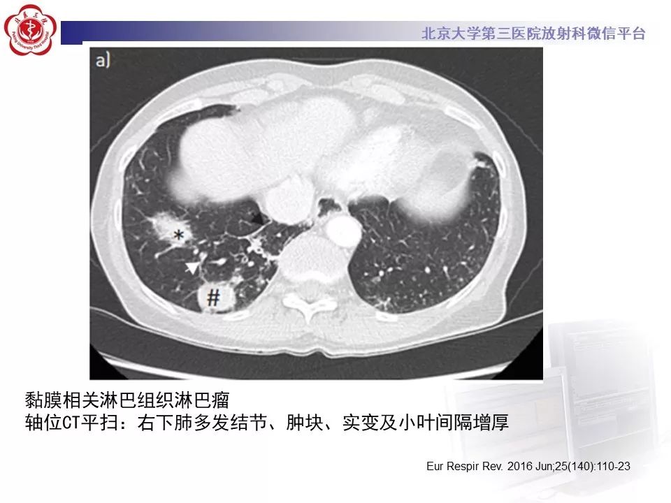 影像PPT - 【PPT】干燥综合征肺部表现-30