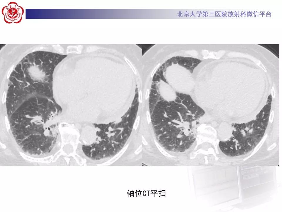 影像PPT - 【PPT】干燥综合征肺部表现-4