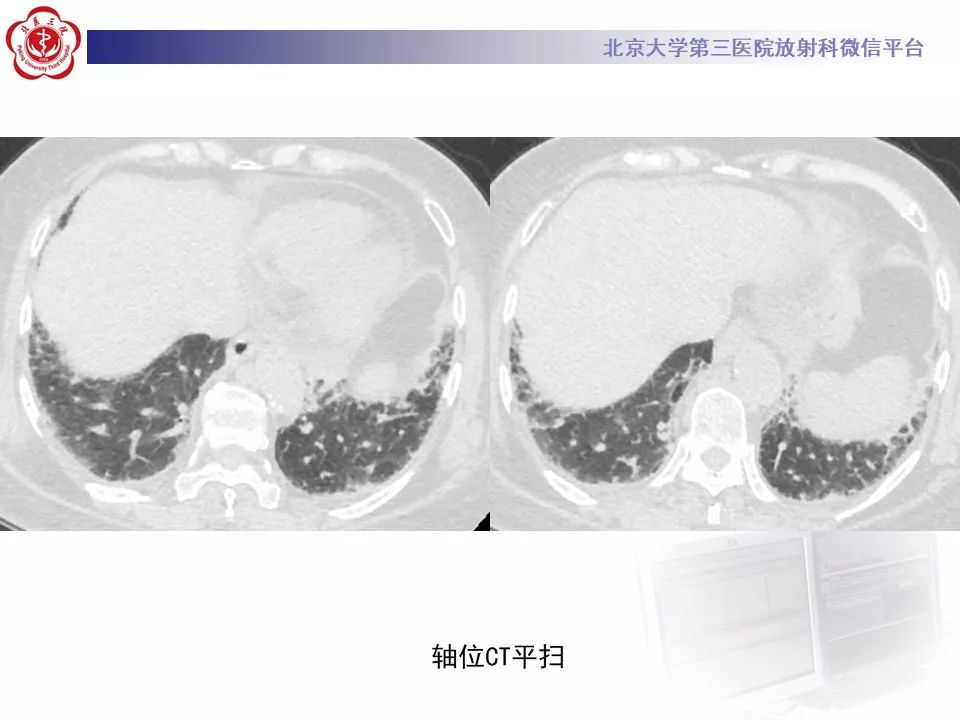 影像PPT - 【PPT】干燥综合征肺部表现-5
