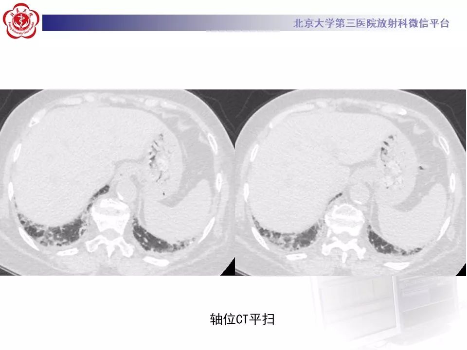 影像PPT - 【PPT】干燥综合征肺部表现-6