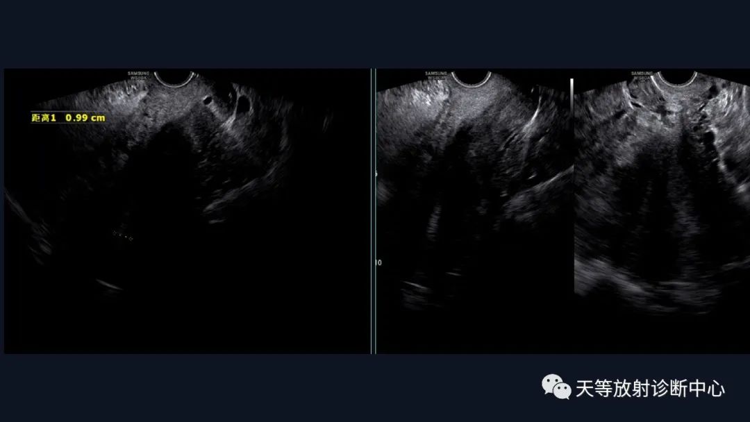 影像PPT - 【病例】播散性腹膜平滑肌瘤病1例MR-3 影像PPT - 【病例】播散性腹膜平滑肌瘤病1例MR-3