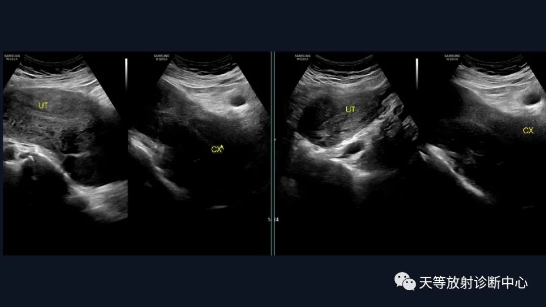 影像PPT - 【病例】播散性腹膜平滑肌瘤病1例MR-8 影像PPT - 【病例】播散性腹膜平滑肌瘤病1例MR-8