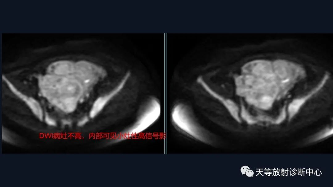 影像PPT - 【病例】播散性腹膜平滑肌瘤病1例MR-13 影像PPT - 【病例】播散性腹膜平滑肌瘤病1例MR-13