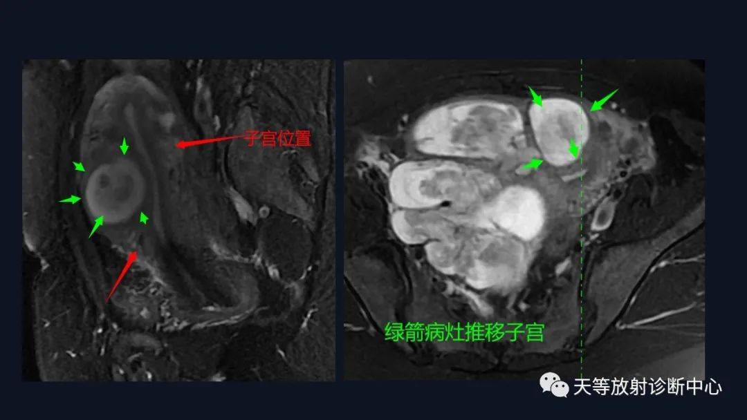 影像PPT - 【病例】播散性腹膜平滑肌瘤病1例MR-11 影像PPT - 【病例】播散性腹膜平滑肌瘤病1例MR-11