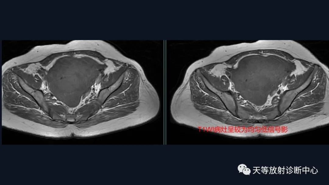 影像PPT - 【病例】播散性腹膜平滑肌瘤病1例MR-12 影像PPT - 【病例】播散性腹膜平滑肌瘤病1例MR-12