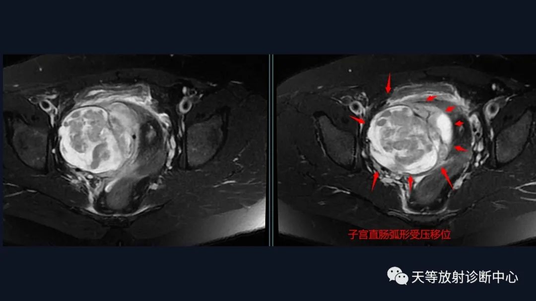 影像PPT - 【病例】播散性腹膜平滑肌瘤病1例MR-9 影像PPT - 【病例】播散性腹膜平滑肌瘤病1例MR-9