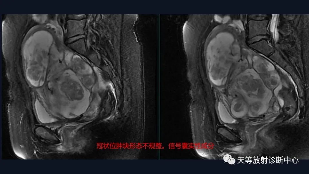 影像PPT - 【病例】播散性腹膜平滑肌瘤病1例MR-10 影像PPT - 【病例】播散性腹膜平滑肌瘤病1例MR-10