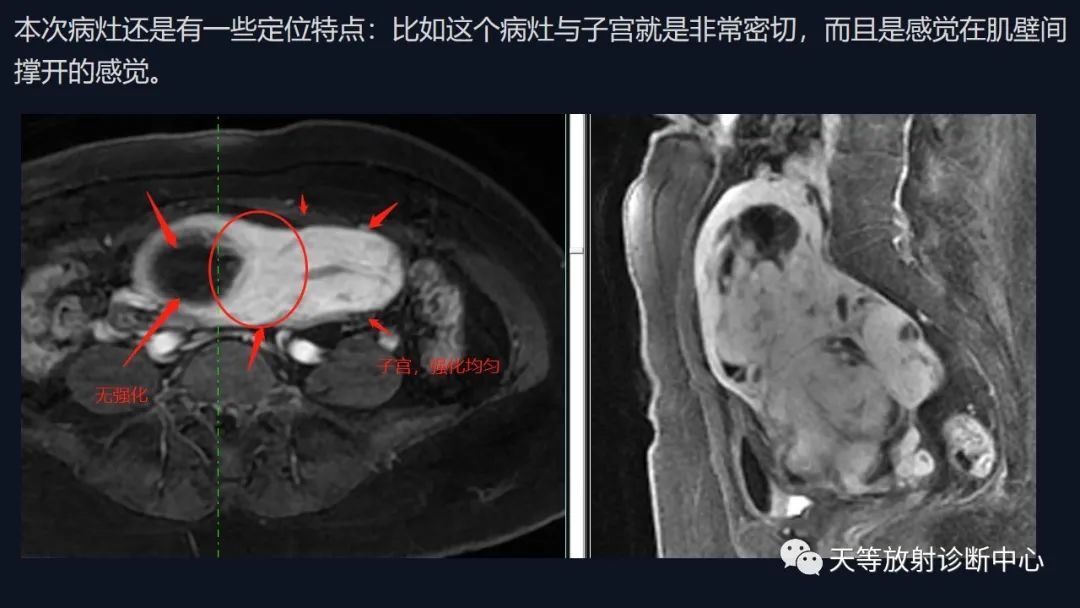 影像PPT - 【病例】播散性腹膜平滑肌瘤病1例MR-16 影像PPT - 【病例】播散性腹膜平滑肌瘤病1例MR-16