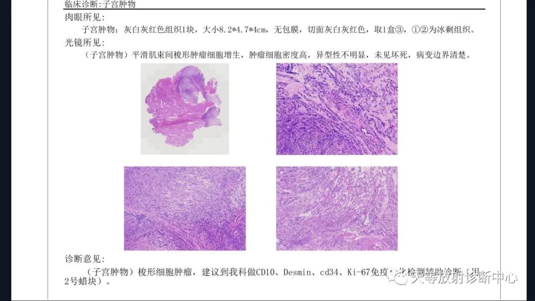 影像PPT - 【病例】播散性腹膜平滑肌瘤病1例MR-19 影像PPT - 【病例】播散性腹膜平滑肌瘤病1例MR-19