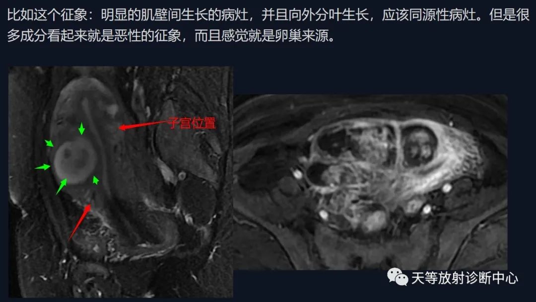 影像PPT - 【病例】播散性腹膜平滑肌瘤病1例MR-17 影像PPT - 【病例】播散性腹膜平滑肌瘤病1例MR-17