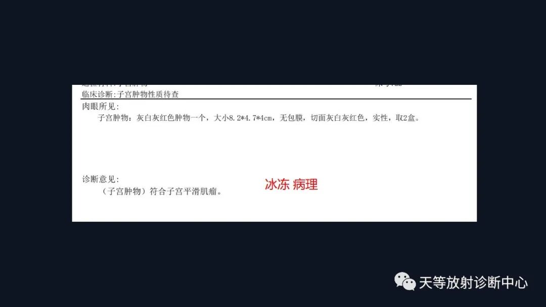 影像PPT - 【病例】播散性腹膜平滑肌瘤病1例MR-18 影像PPT - 【病例】播散性腹膜平滑肌瘤病1例MR-18