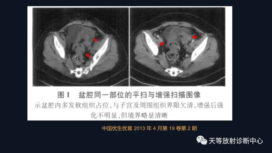 影像PPT - 【病例】播散性腹膜平滑肌瘤病1例MR-20 影像PPT - 【病例】播散性腹膜平滑肌瘤病1例MR-20