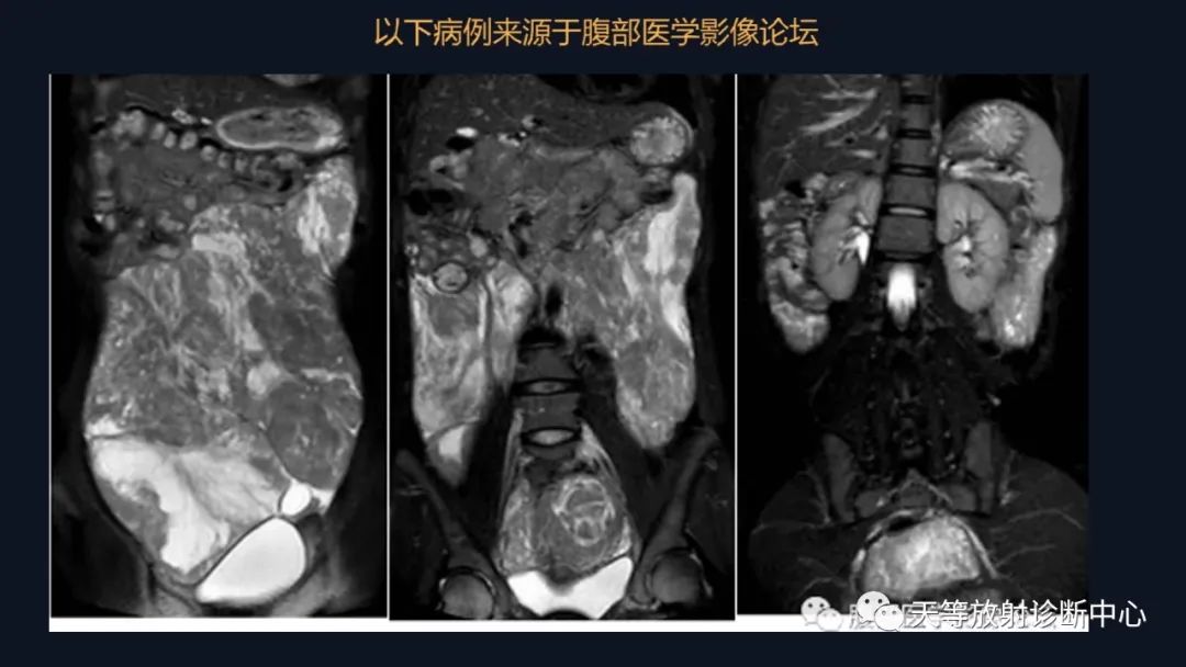 影像PPT - 【病例】播散性腹膜平滑肌瘤病1例MR-22 影像PPT - 【病例】播散性腹膜平滑肌瘤病1例MR-22