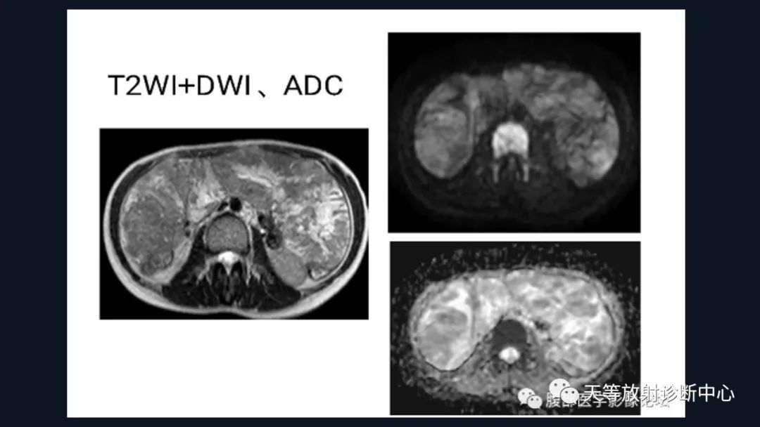 影像PPT - 【病例】播散性腹膜平滑肌瘤病1例MR-23 影像PPT - 【病例】播散性腹膜平滑肌瘤病1例MR-23