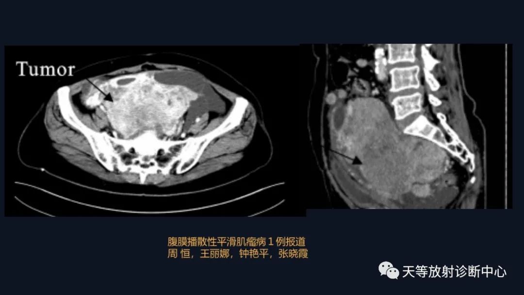 影像PPT - 【病例】播散性腹膜平滑肌瘤病1例MR-21 影像PPT - 【病例】播散性腹膜平滑肌瘤病1例MR-21