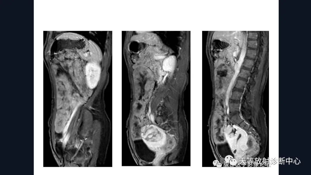影像PPT - 【病例】播散性腹膜平滑肌瘤病1例MR-27 影像PPT - 【病例】播散性腹膜平滑肌瘤病1例MR-27