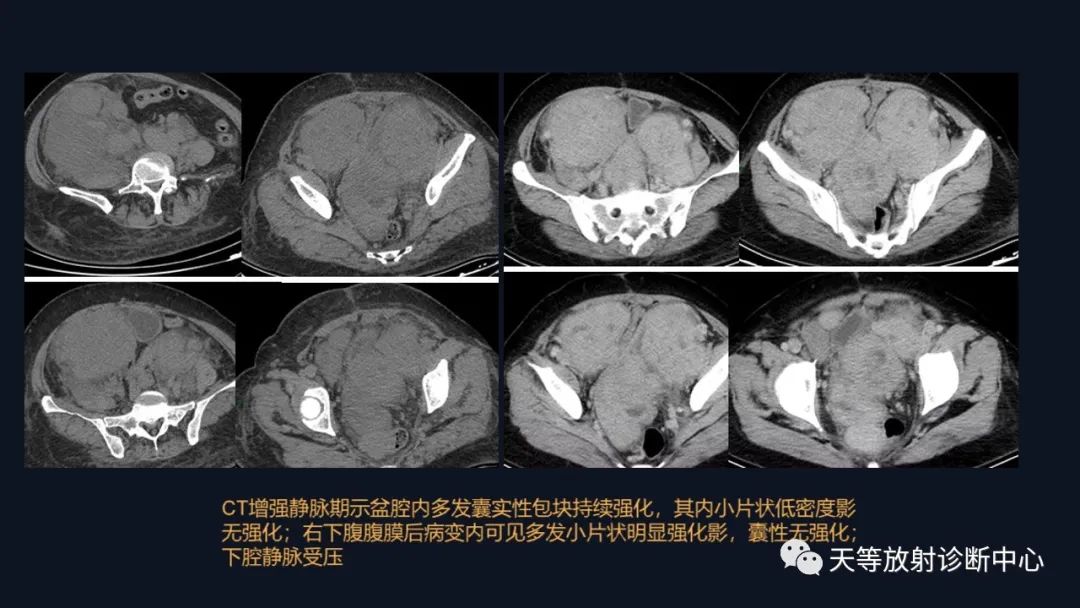 影像PPT - 【病例】播散性腹膜平滑肌瘤病1例MR-29 影像PPT - 【病例】播散性腹膜平滑肌瘤病1例MR-29