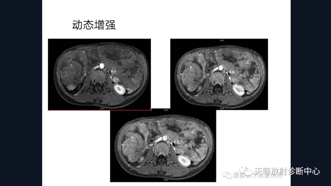 影像PPT - 【病例】播散性腹膜平滑肌瘤病1例MR-26 影像PPT - 【病例】播散性腹膜平滑肌瘤病1例MR-26