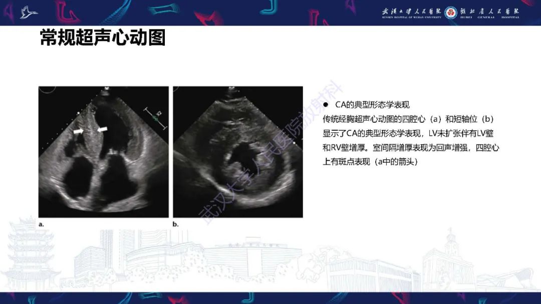 影像PPT - 【PPT】心肌淀粉样变影像诊断-15
