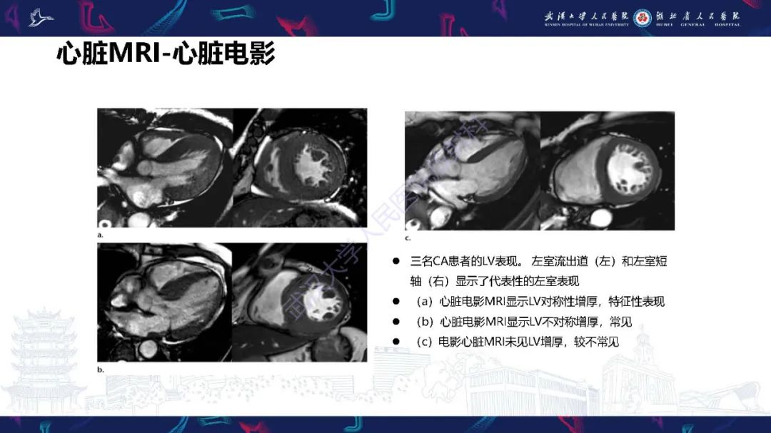 影像PPT - 【PPT】心肌淀粉样变影像诊断-19