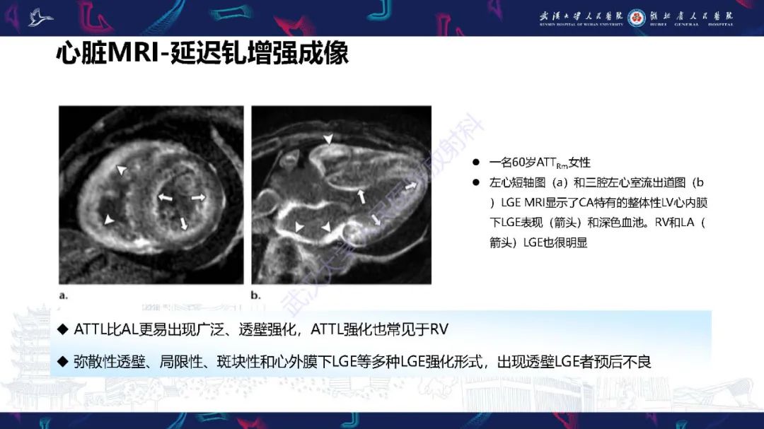 影像PPT - 【PPT】心肌淀粉样变影像诊断-21