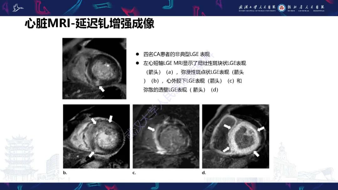 影像PPT - 【PPT】心肌淀粉样变影像诊断-22