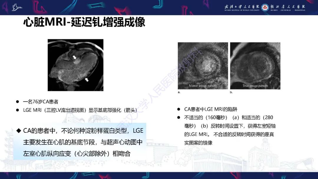 影像PPT - 【PPT】心肌淀粉样变影像诊断-24