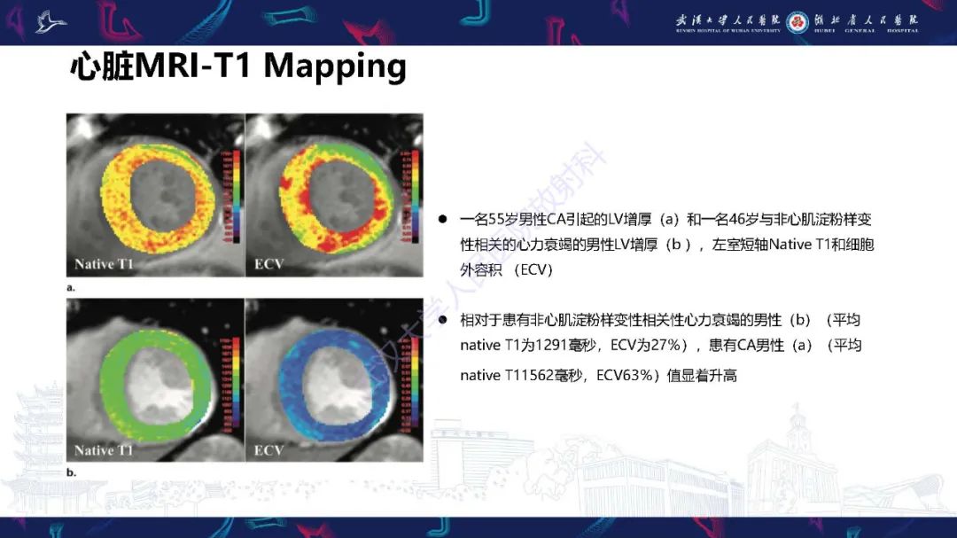 影像PPT - 【PPT】心肌淀粉样变影像诊断-26
