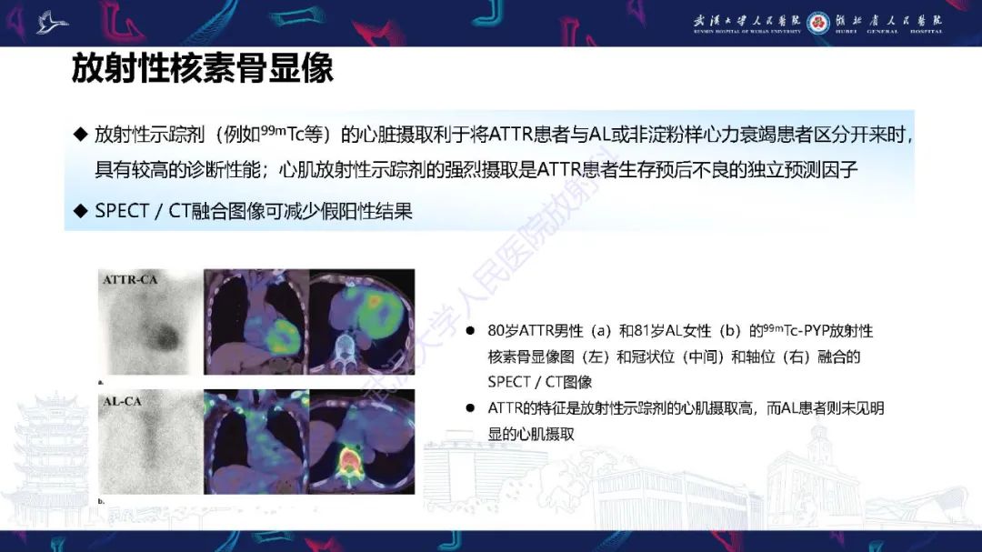 影像PPT - 【PPT】心肌淀粉样变影像诊断-33