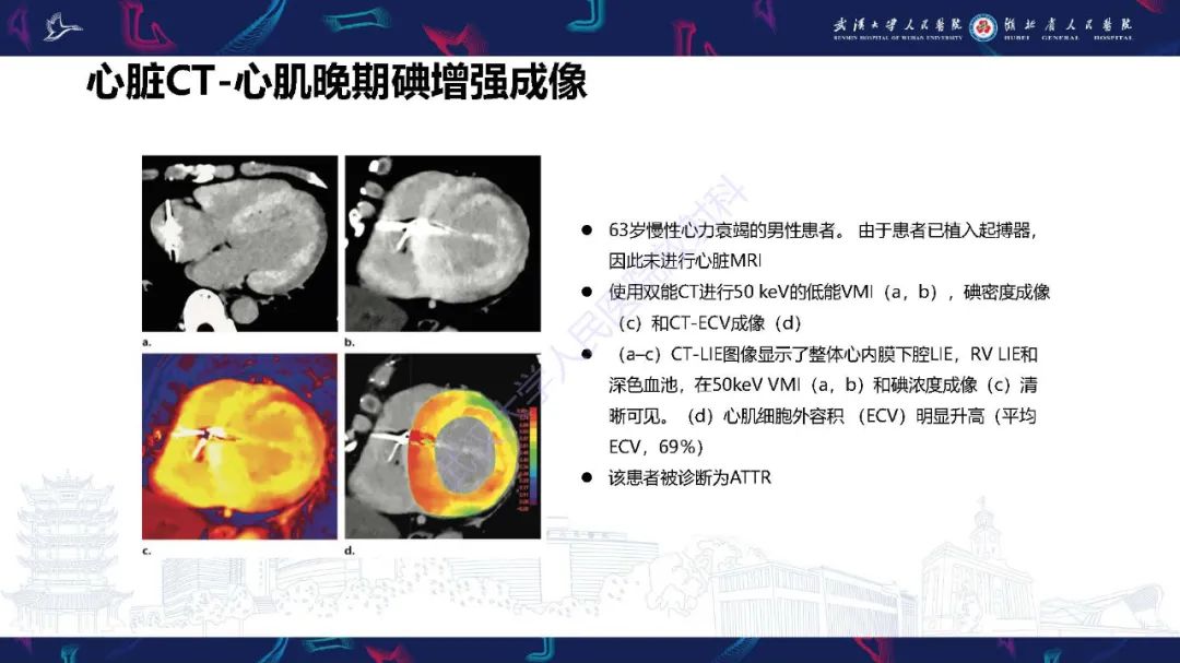 影像PPT - 【PPT】心肌淀粉样变影像诊断-36