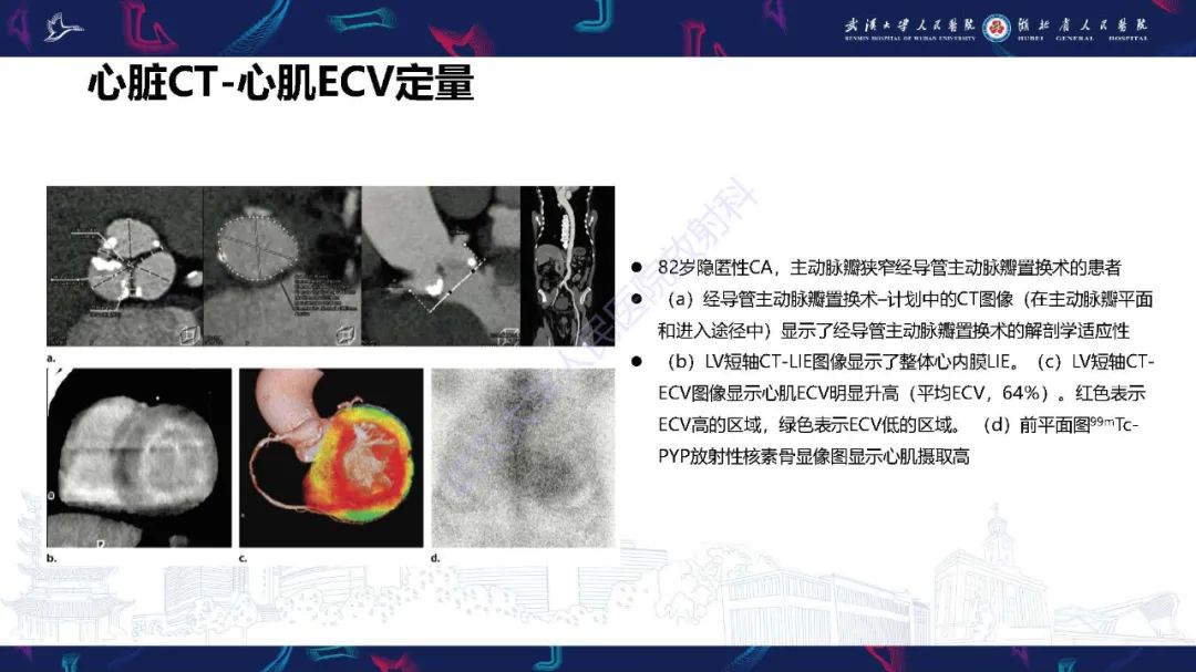 影像PPT - 【PPT】心肌淀粉样变影像诊断-38