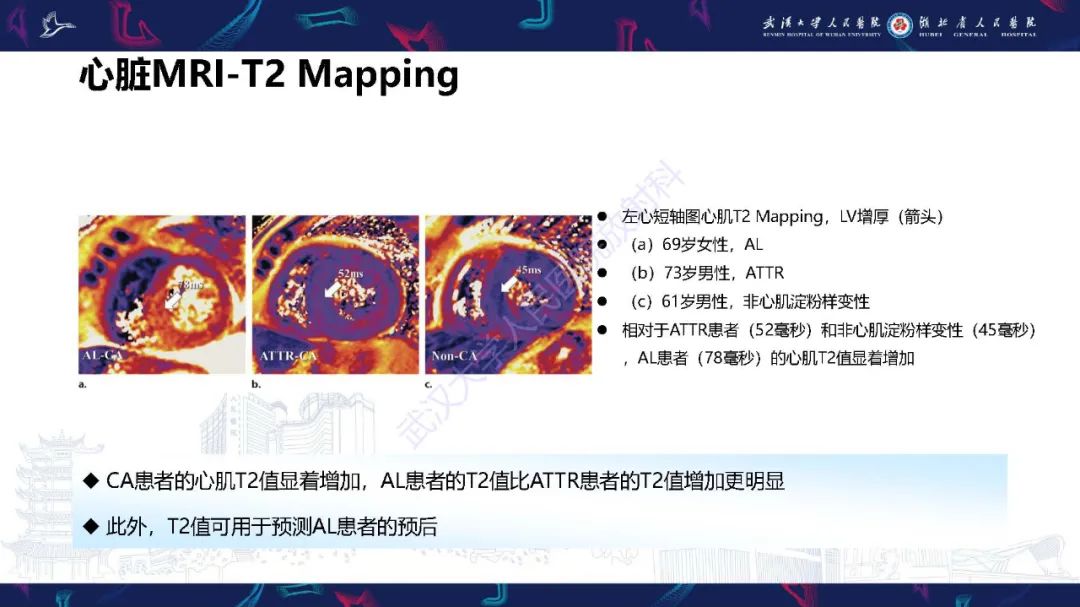 影像PPT - 【PPT】心肌淀粉样变影像诊断-1