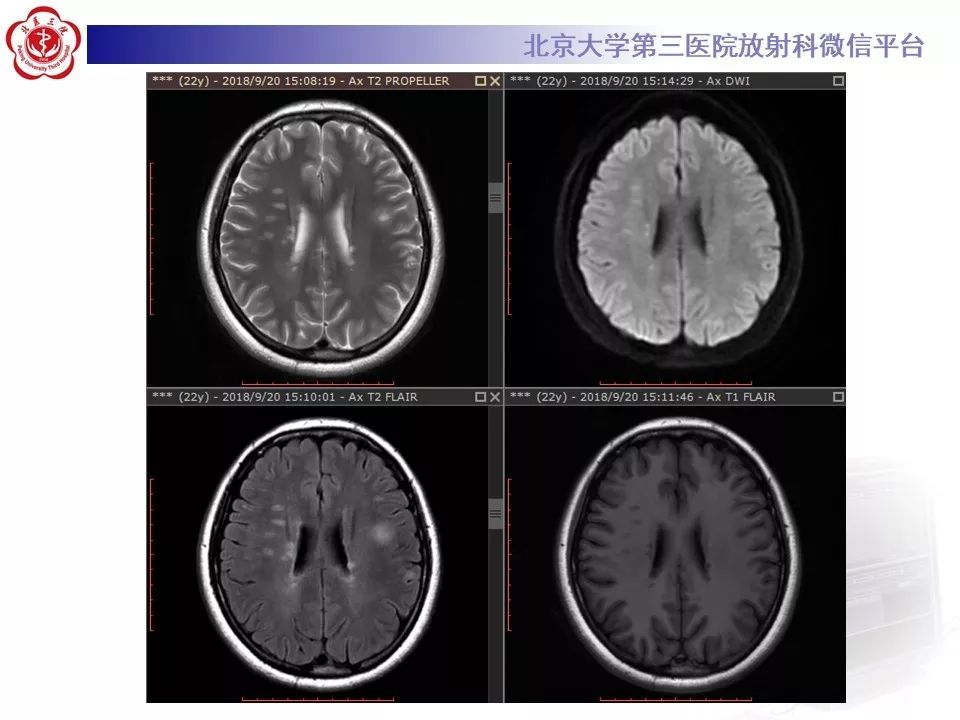 影像PPT - 【PPT】多发性硬化的影像-5