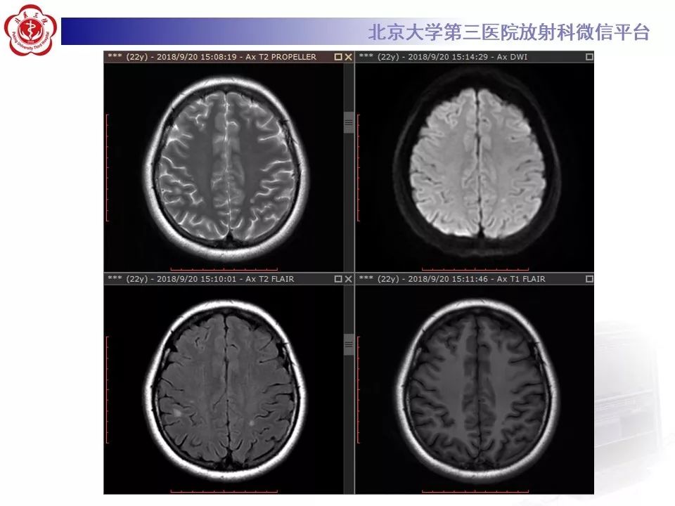 影像PPT - 【PPT】多发性硬化的影像-4
