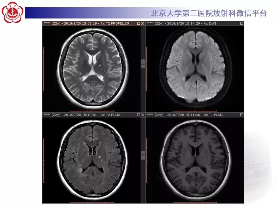 影像PPT - 【PPT】多发性硬化的影像-6