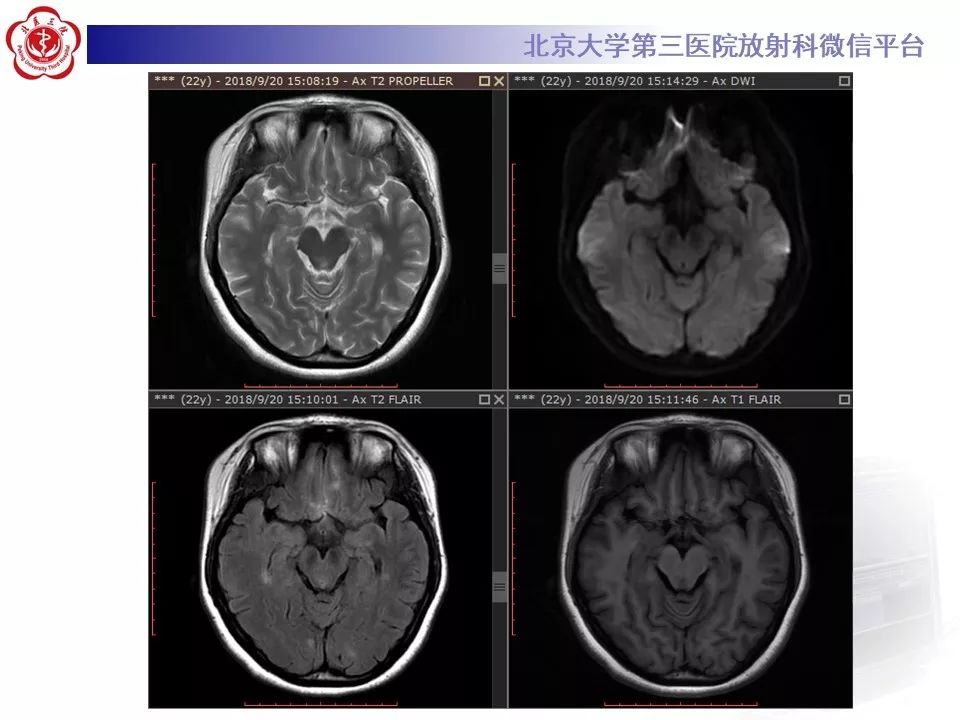 影像PPT - 【PPT】多发性硬化的影像-7