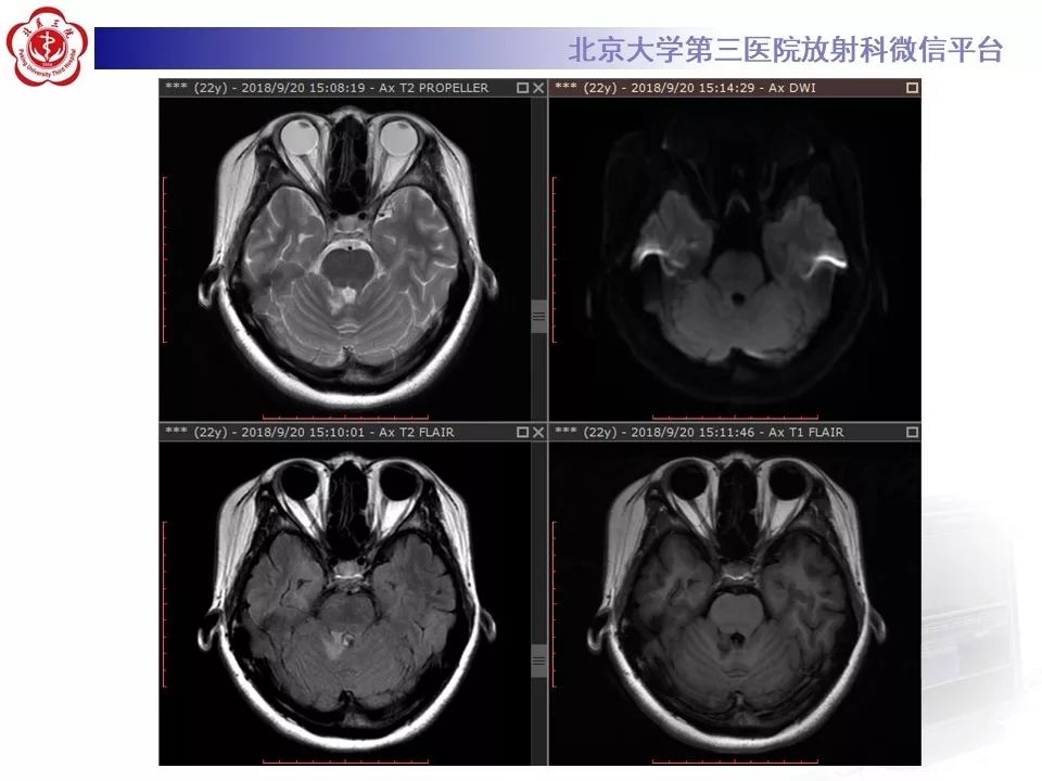 影像PPT - 【PPT】多发性硬化的影像-8