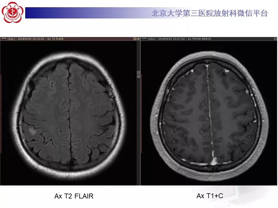影像PPT - 【PPT】多发性硬化的影像-9