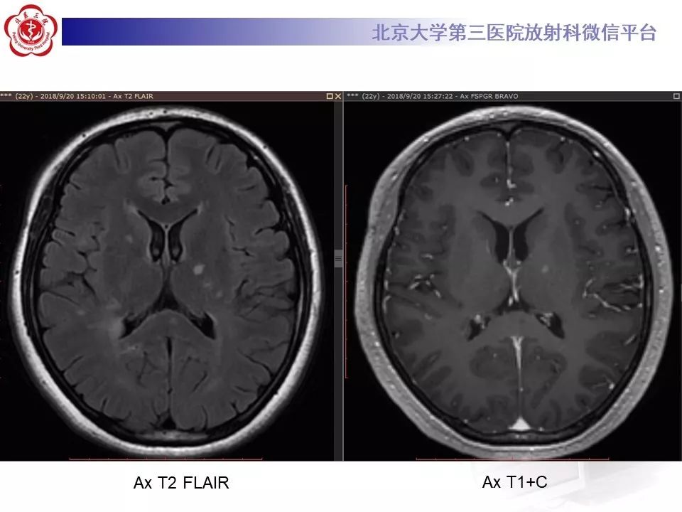 影像PPT - 【PPT】多发性硬化的影像-11