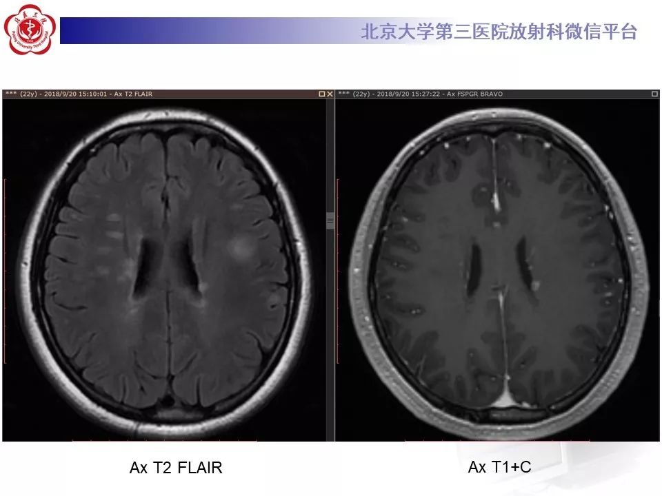 影像PPT - 【PPT】多发性硬化的影像-10