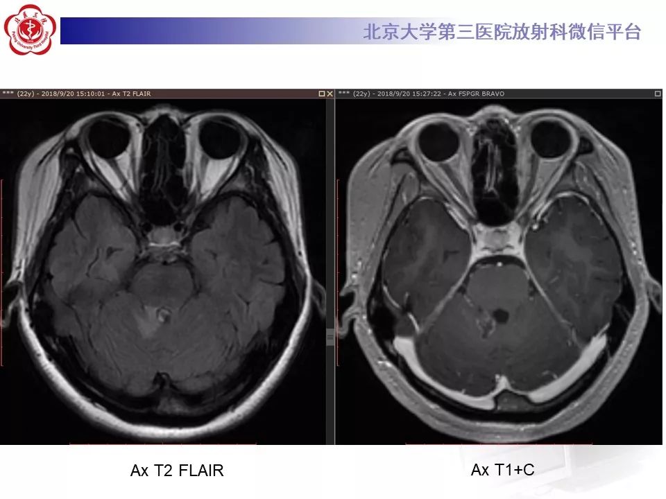 影像PPT - 【PPT】多发性硬化的影像-12