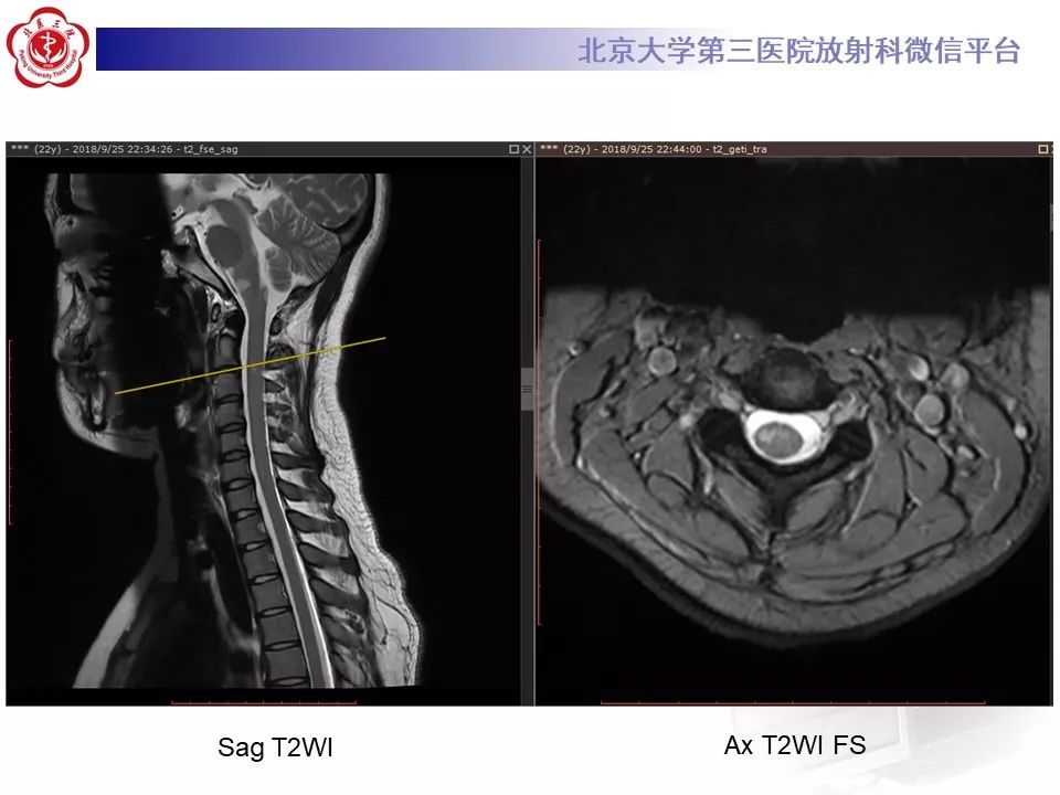 影像PPT - 【PPT】多发性硬化的影像-14